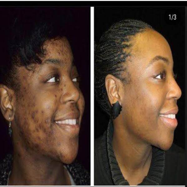 Byenblan Face cream 4 oz Skin Black Remover Melasma dark Spots - Image 3